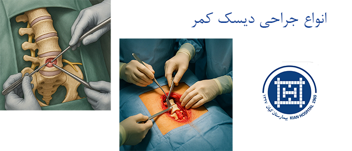 انواع جراحی دیسک کمر