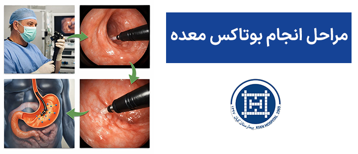 مراحل انجام بوتاکس معده
